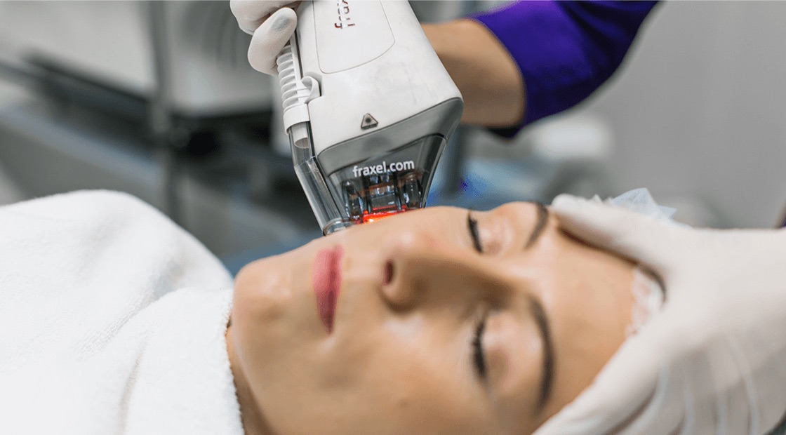 Illustrative image of Fraxel – Non Ablative Laser Resurfacing