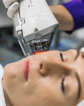 Illustrative image of Fraxel – Non Ablative Laser Resurfacing