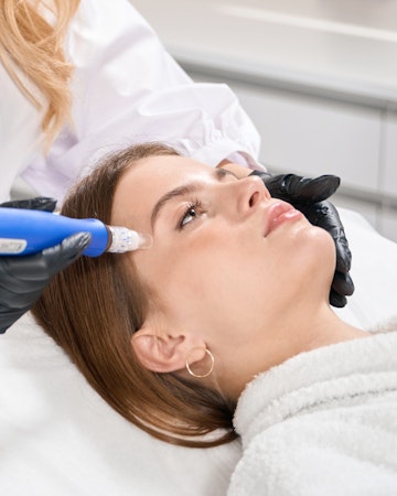 Illustrative image of SkinPen Microneedling