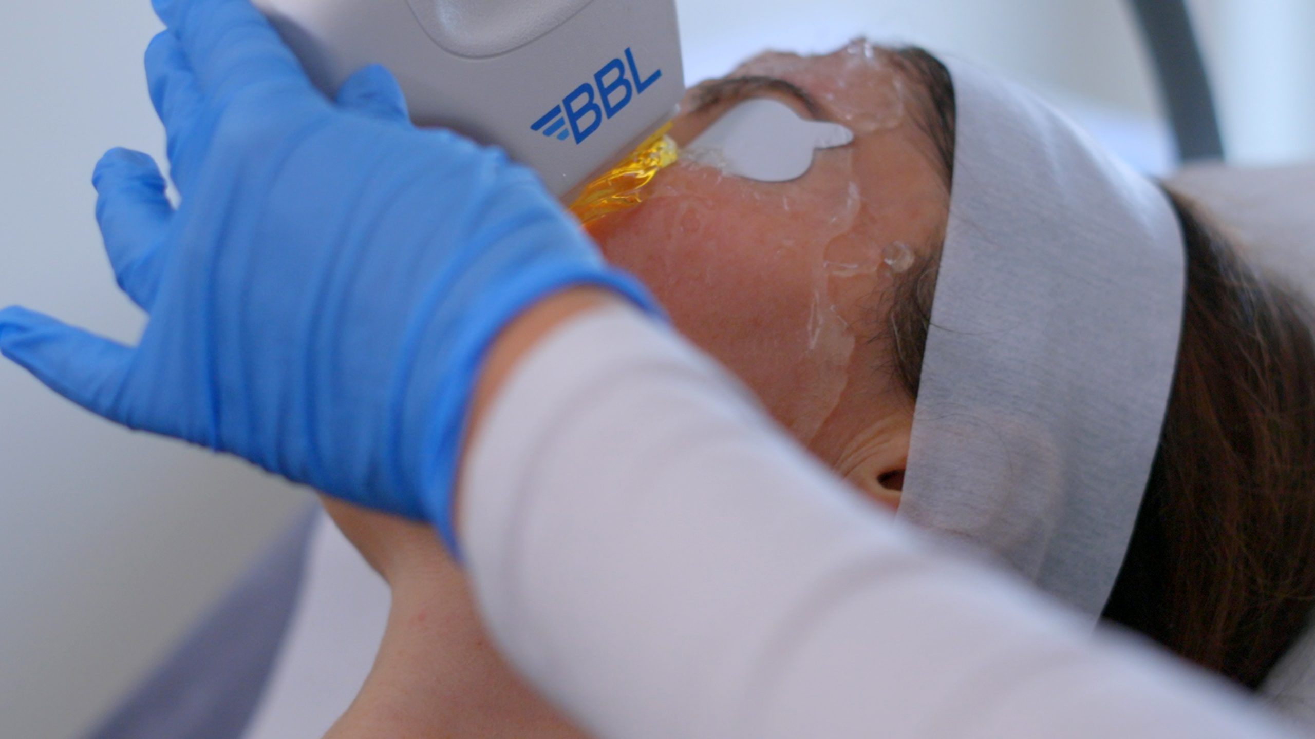 Broad Band Light – BBL™ procedure at River Medical Dublin & Belfast